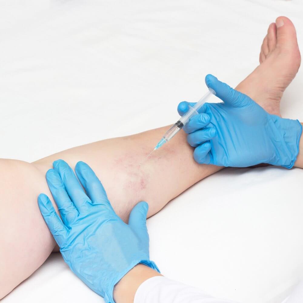 sclerotherapy-img